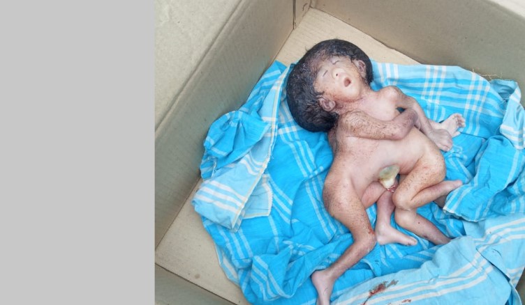 নাটোরে এক মাথা ৪হাত৪পা বিশিষ্ঠ মৃত যমজ শিশুর জন্ম
