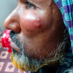 নাটোরে অসুস্থ গরুর মাংস খেয়ে কমপক্ষে ছয়জন তড়কা রোগে আক্রান্ত 