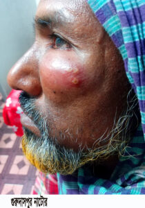 নাটোরে অসুস্থ গরুর মাংস খেয়ে কমপক্ষে ছয়জন তড়কা রোগে আক্রান্ত 